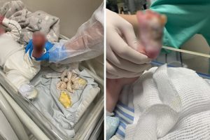 Bebê que sofreu queimadura no pé esquerdo